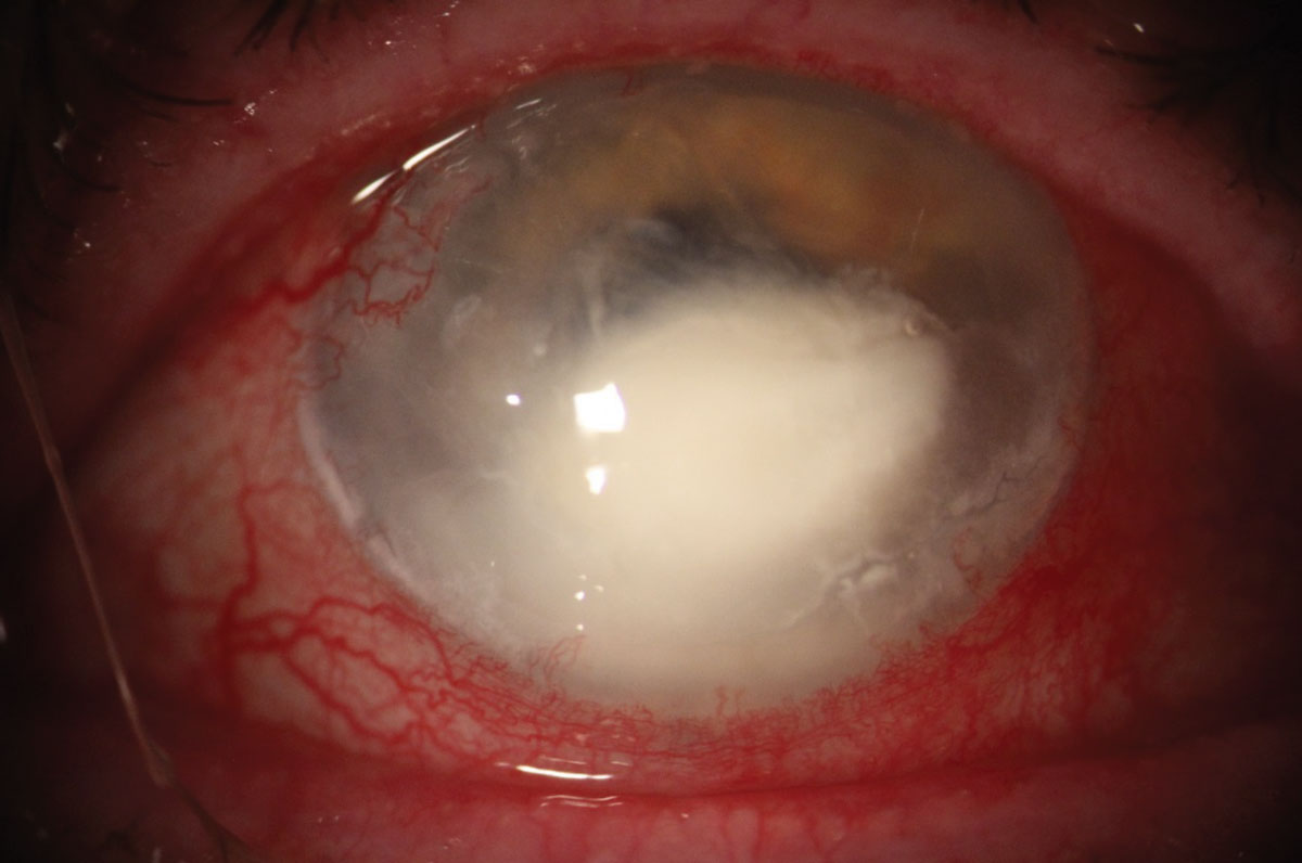 Corneal ulcer occurrence may be linked to warmer climates, as shown through social media posts and online searches.