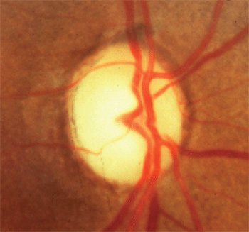 Even if current evidence on the association between the two is limited, assess all patients experiencing visual impairment symptoms during COVID-19.