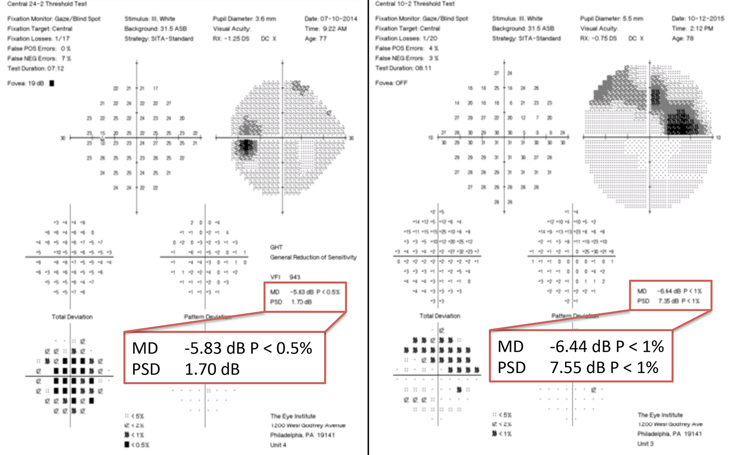 In many scenarios, 10-2 VF testing (right) can be more sensitive than 24-2 (left).