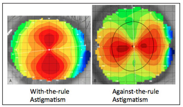 Be mindful of oblique and ATR astigmatism in high myopes, study advises.