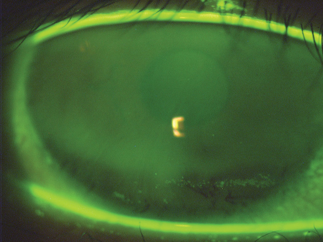 This image depicts inferior dehydration staining due to incomplete blinking. The darker horizontal band in the stained area corresponds to the turning point of the lid between the downward and upward motion of the blink.