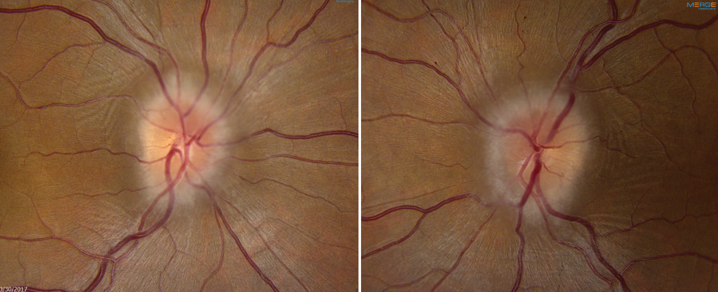 Patients with IIH and anemia tend to suffer from worse visual outcomes.