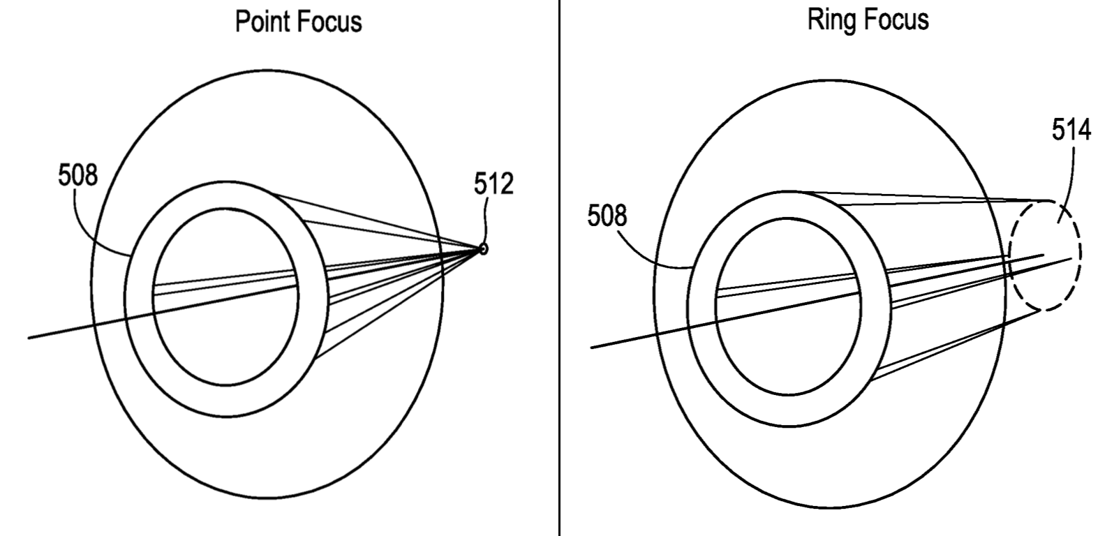 This study, funded by J&J, touts the advantage of optics that create a ring focus (right) rather than the point focus (left) of existing lenses. The company’s prototype soft contact lens for myopia has a more significant effect on slowing disease progression than single-vision or dual-focus lenses, according to the study.