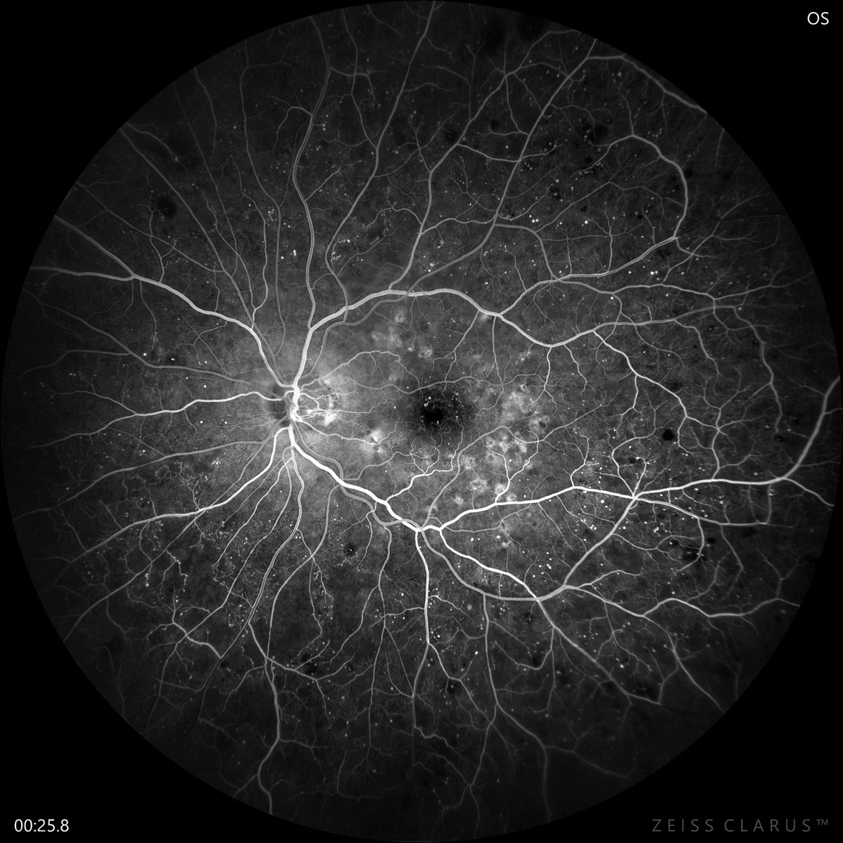 The choroidal vascular density differs depending on where a patient falls on the DR spectrum.