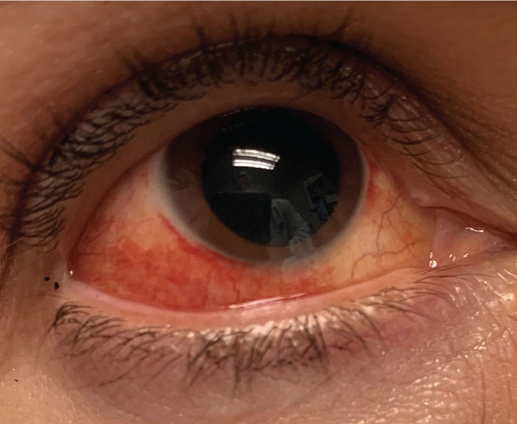 Using a dynamic algorithm to determine the urgency of red eye cases may be more effective than using a static flowchart, researchers found.