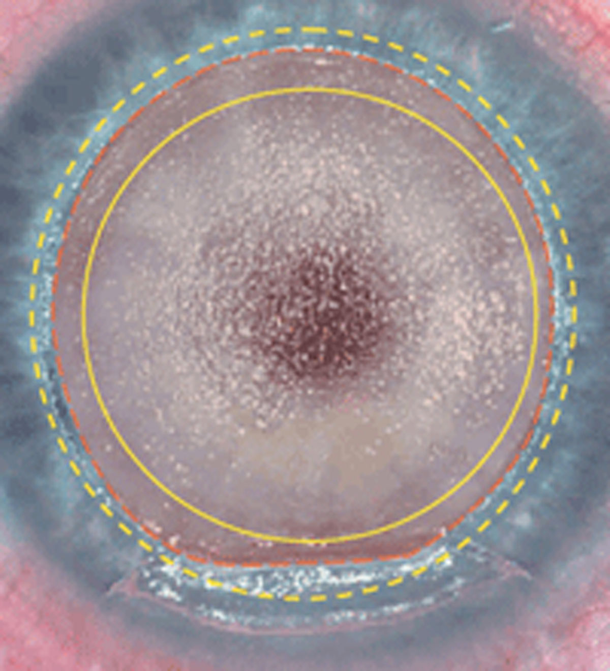 LASIK reduces dendritic cell density in the central cornea, creating a stimulus for cellular migration to the area. These changes may manifest clinically as ocular surface disruption and pain long after the surgery.