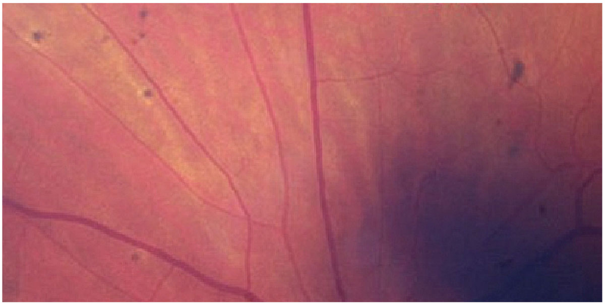 Fig. 1. Elschnig spots seen in a patient with hypertensive retinopathy.