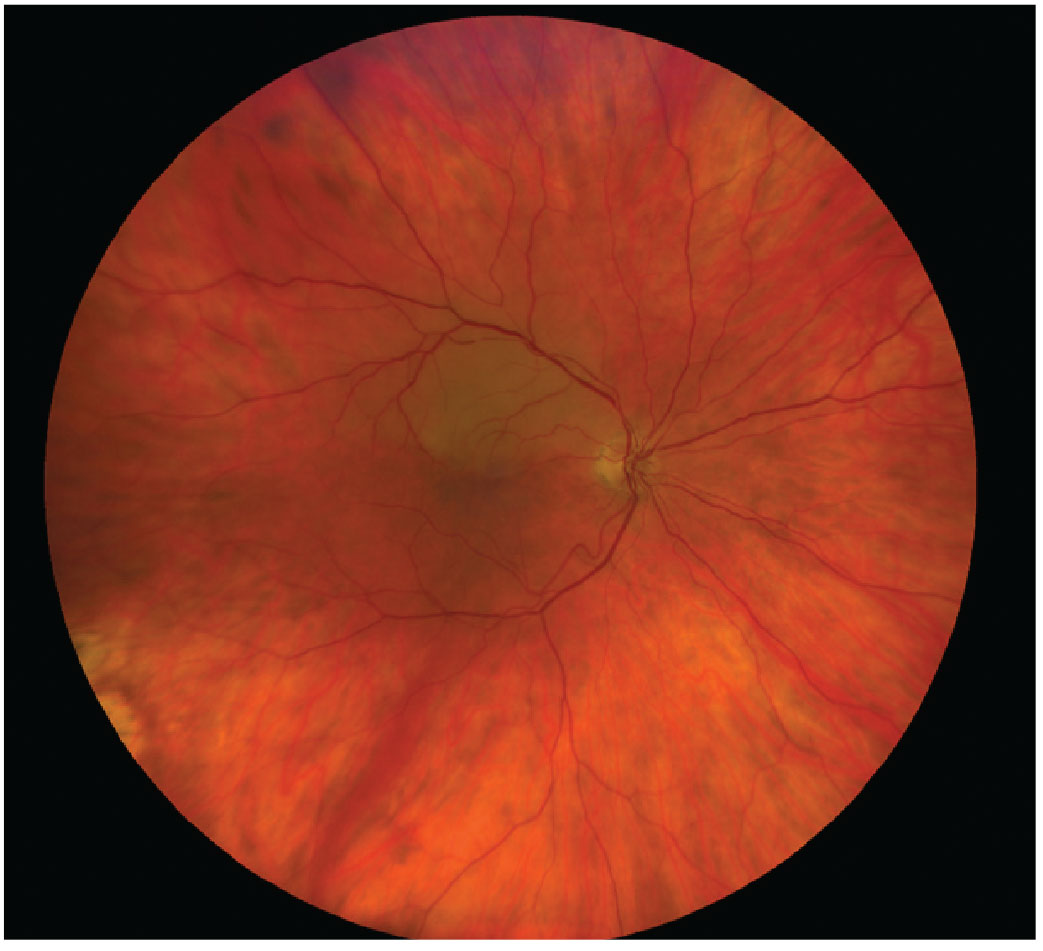 Fig. 6. BRVO is a form of acute retinal arterial ischemia that is considered both ocular and systemic emergencies requiring proper and immediate diagnosis and management.