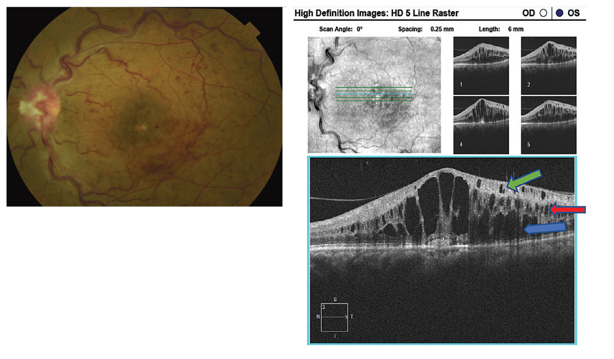 Fig. 1. Fundus photography demonstrating an ischemic retinal vein occlusion with, at right, SD-OCT illustrating the presence of cystoid macula edema with cysts located in the outer nuclear layer (blue arrow), inner nuclear (red arrow) and ganglion cell layer (green arrow). 