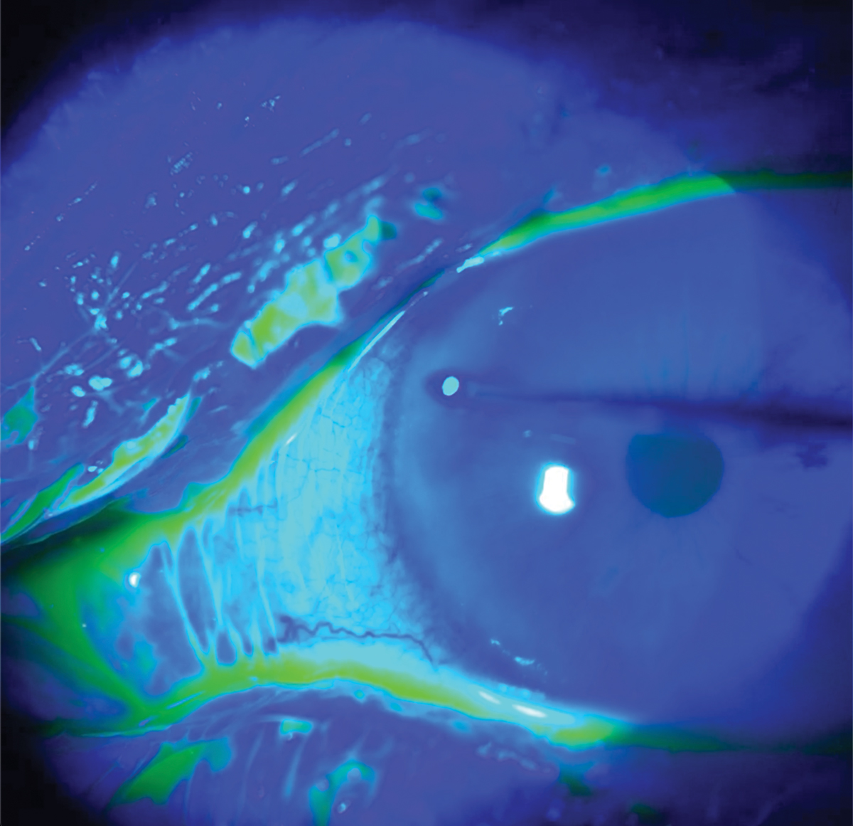 The cornea sweep test can help identify this acute and chronic condition.
