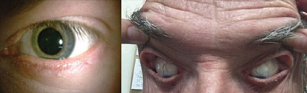 Patients with OSA may develop lash ptosis (left) and/or floppy eyelid syndrome (right).