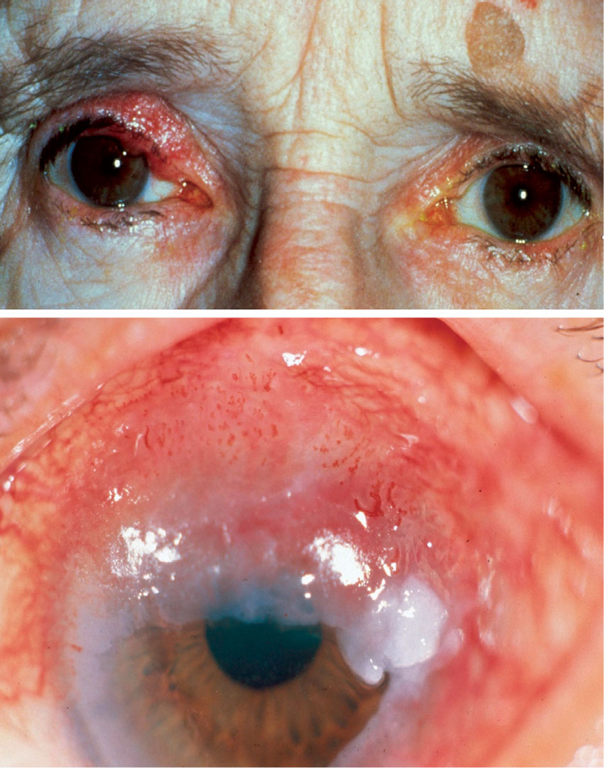 Experts advise optometrists to be vigilant for clinical signs of sebaceous gland carcinoma.