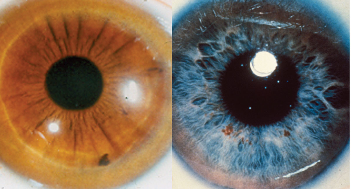 The genetic disorder Wilson’s disease manifests in the eye as a Kayser-Fleischer ring.