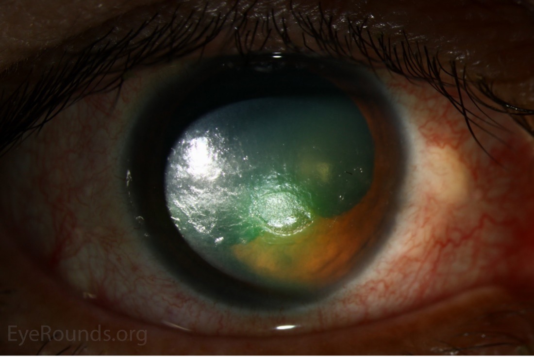 Fig. 2. This image shows a patient with a neurotropic corneal ulcer, a finding that may present in some patients with poorly controlled diabetes.