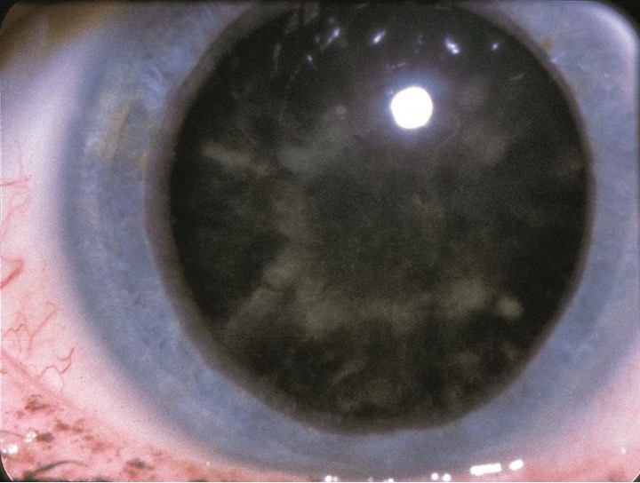 Fig. 3. This patient has what’s been coined a “snowflake cataract,” a rare complication mainly seen in patients with poorly controlled type 1 diabetes.