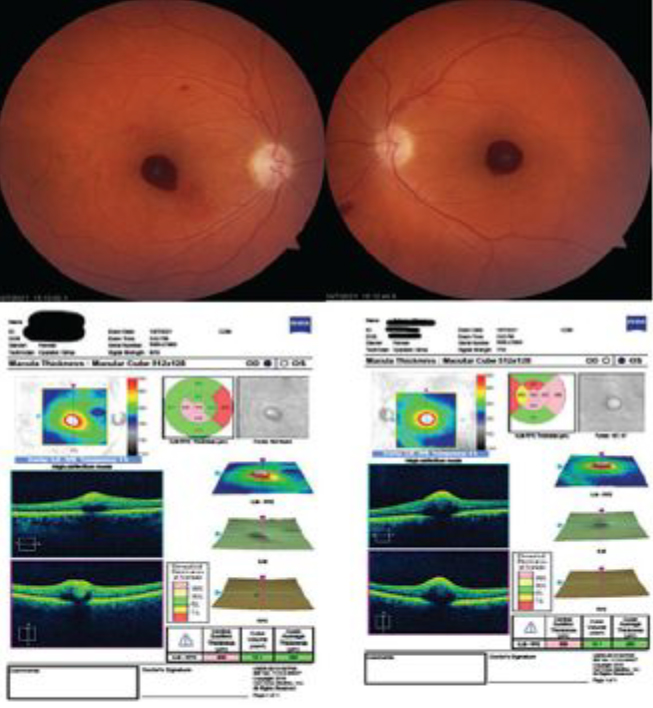 Fig. 1. Fundus exam revealed bilateral preretinal hemorrhages, and corresponding OCT imaging.