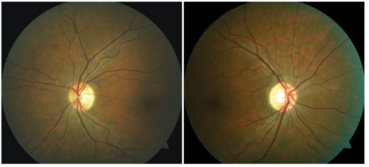 Asymptomatic bi-temporal optic disc pallor representing progressive demyelination of the optic nerve without a history of optic neuritis.