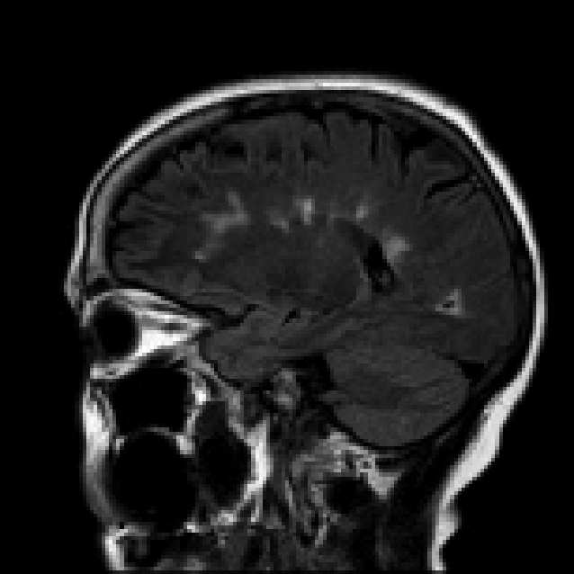 Demyelinating plaques within the cerebral hemispheres.