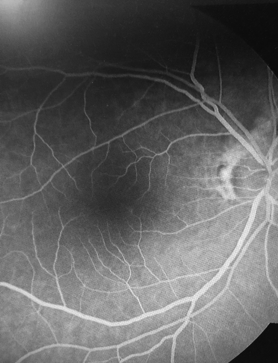 Normal fluorescein angiography of the right eye in a patient with acute vision loss attributed to acute ON.