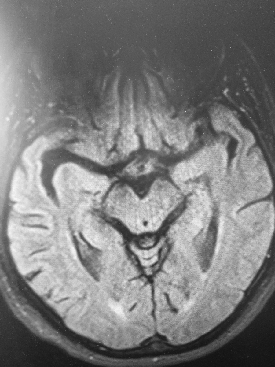 Multifocal white matter lesions in a patient with relapsing and remitting MS.