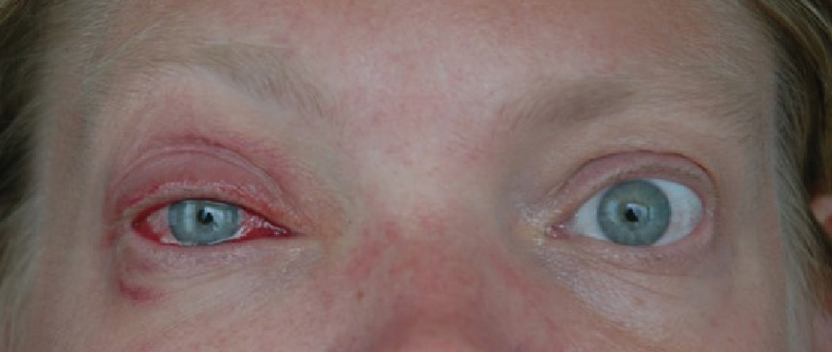 Fig. 1. A patient with unilateral adenoviral conjunctivitis.