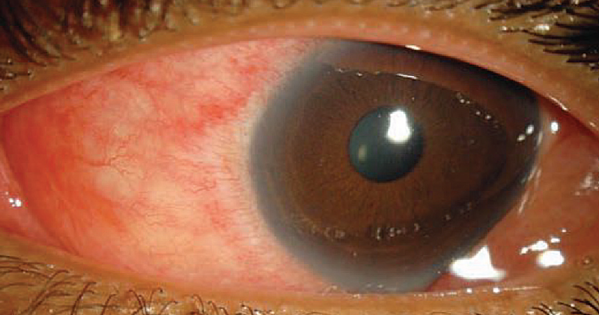 Epidemic keratoconjunctivitis in a 30-year-old woman.