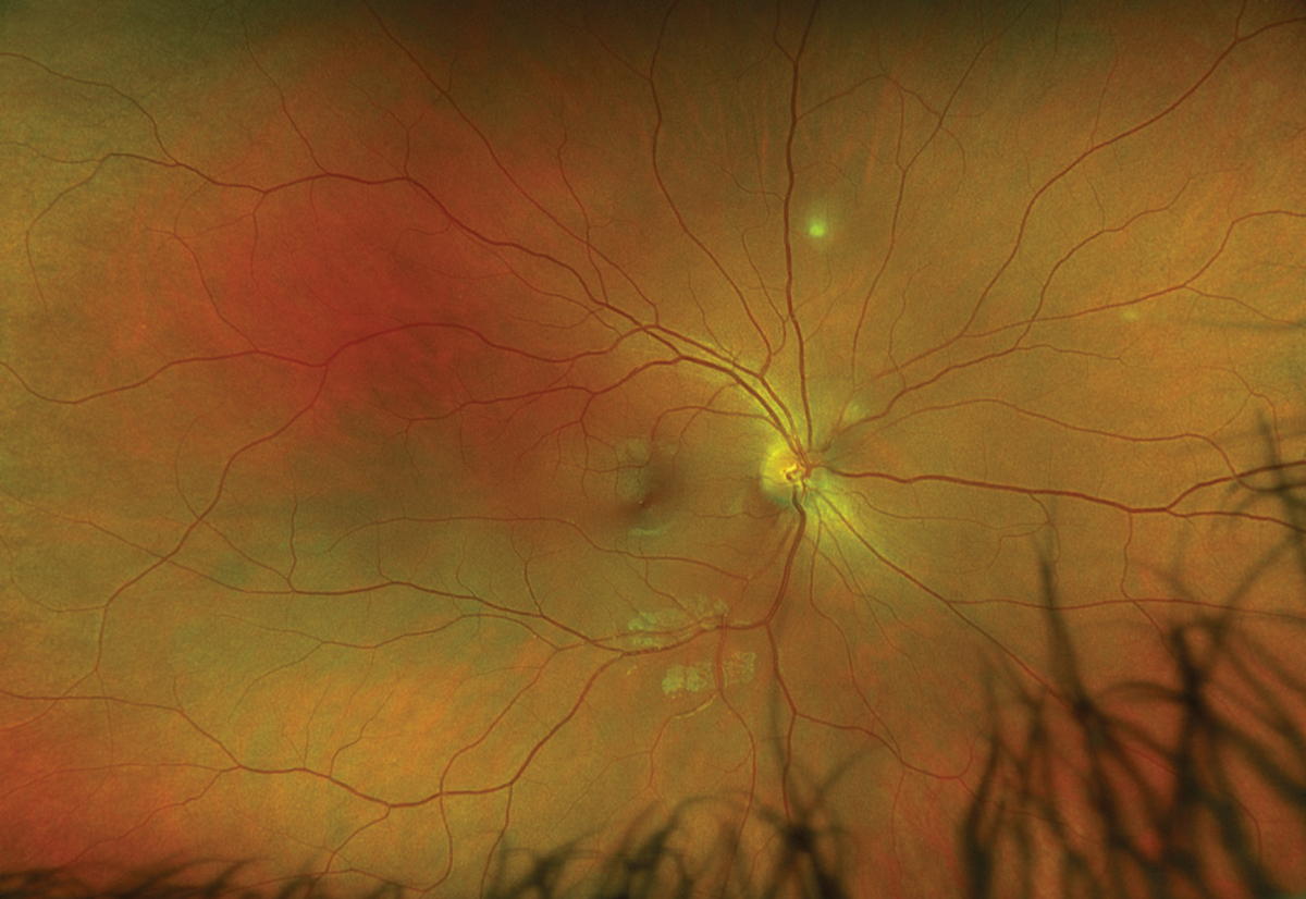 Fig. 1. Optos widefield fundus photography of the right eye.