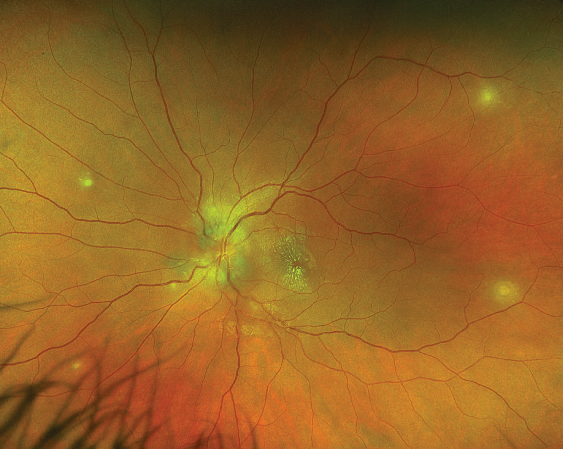 Fig. 2. Optos widefield fundus photography of the left eye.