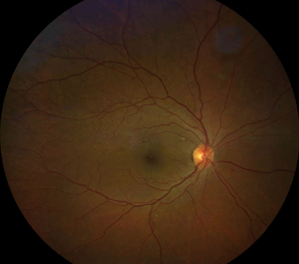 Patient with high Hb A1c and nonproliferative diabetic retinopathy.