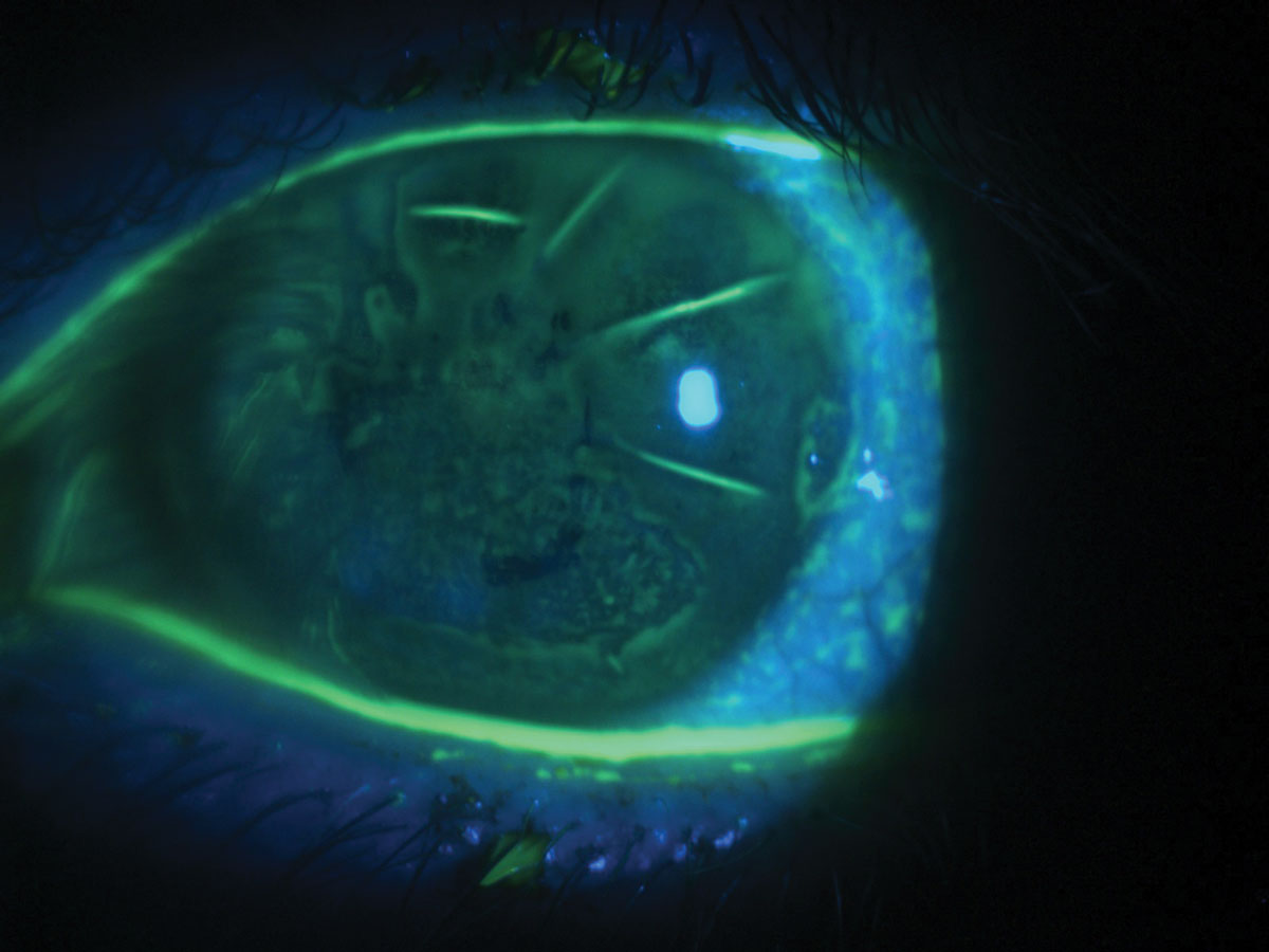 Diffuse corneal staining with fluorescein in a patient with severe dry eye and a history of radial keratotomy.