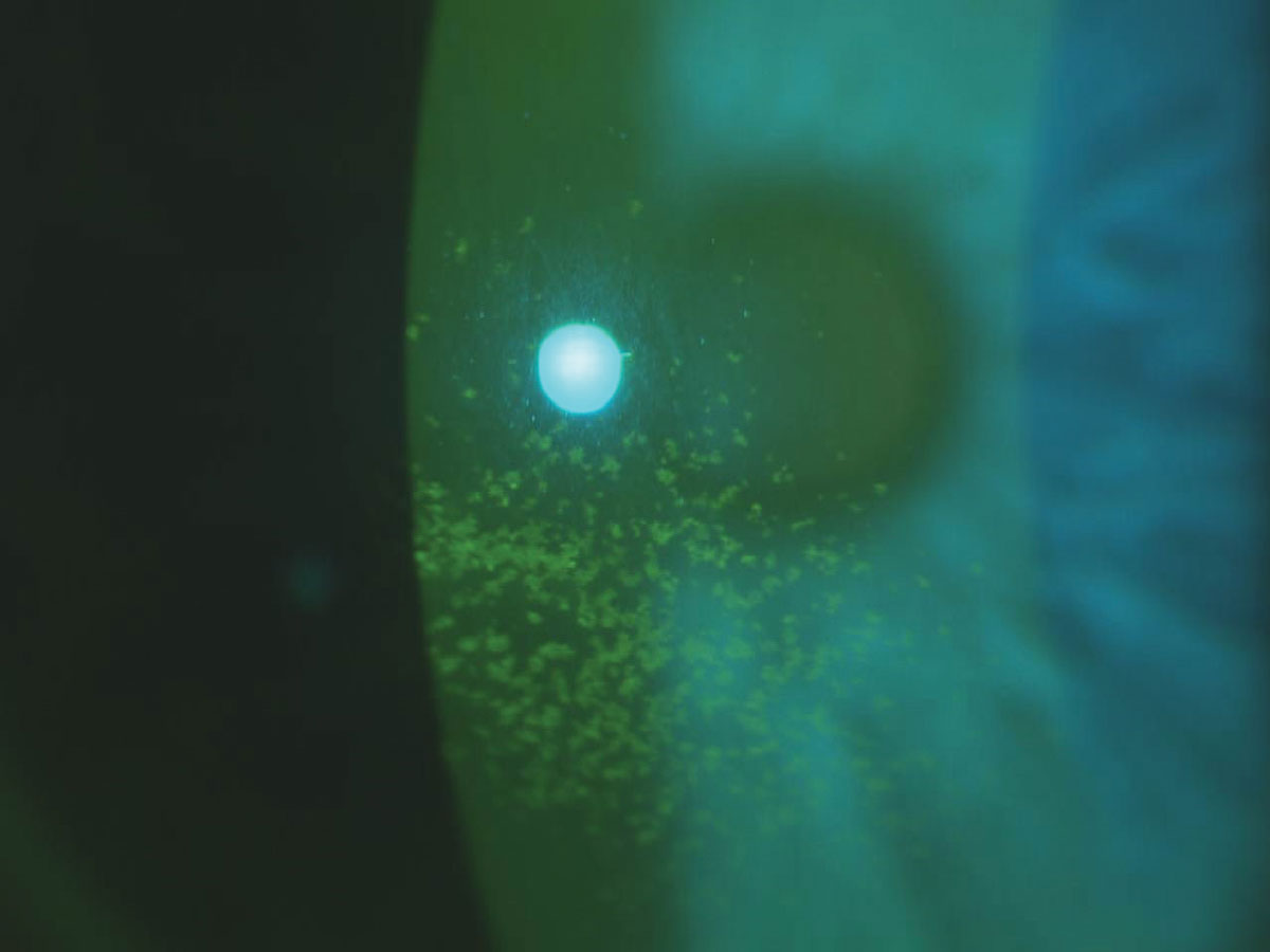 Patients with central corneal staining, as seen here, benefitted most from CyclASol treatment in the drug’s clinical trials.