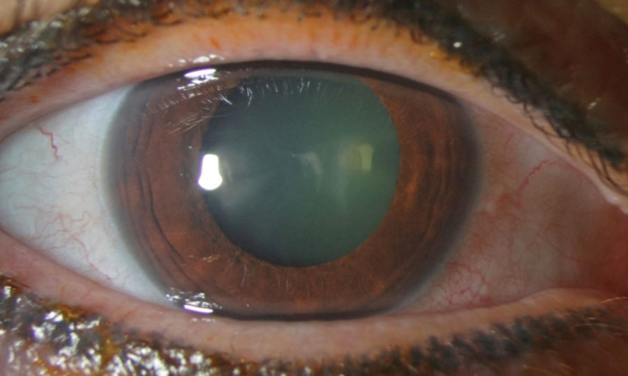 This gross slit lamp photo reveals nasal conjunctival injection and a faint corneal opacity nasal to the center. There is also mild haze visible in the lens of the eye, where a focal cataract is present.