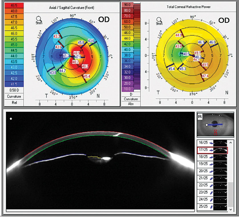Corneal topography and anterior segment Scheimpflug imaging reveal the irregular corneal astigmatism affecting the visual axis (top) and the full-thickness corneal laceration, seen as a hyper-reflective cut through the cornea (bottom).