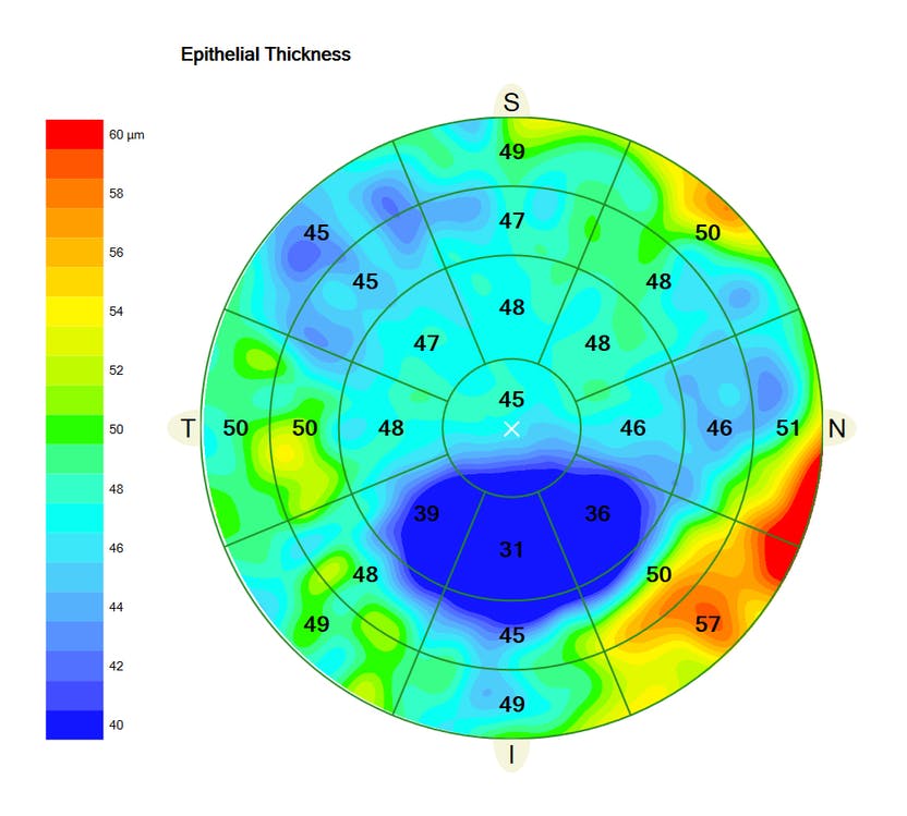 A recent study reported a significant difference between the minimum and maximum epithelial points between stable and keratoconus eyes, with little difference in pachymetry.