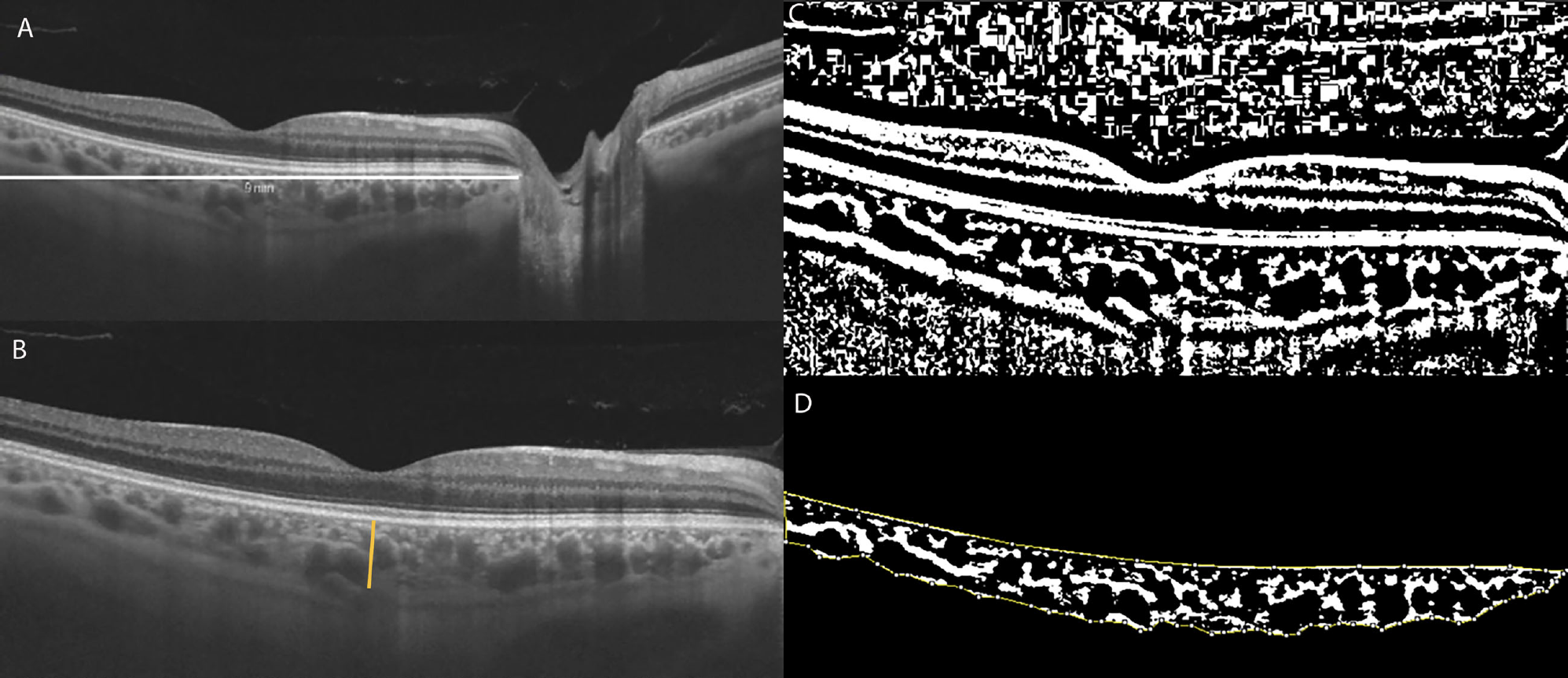 CVI is calculated by demarcating a 9mm horizontal B-scan at the fovea (fig. A, white line) and the subfoveal choroidal thickness (fig. B, orange line). The image is then binarized (fig. C), with the dark pixels representing the vessels’ luminal area and the white pixels the stromal area. Finally, the total choroidal area—the space between the yellow lines—is isolated with the RPE representing the anterior boundary and the scleral-choroidal interface as the posterior boundary, across the entire length of the scan. Total luminal area divided by total choroidal area represents the CVI, a measure of the structure’s vascular capacity. The study in question found a lower CVI in DR patients, indicating that low perfusion and proliferative changes are the major pathological effects in the choroid.