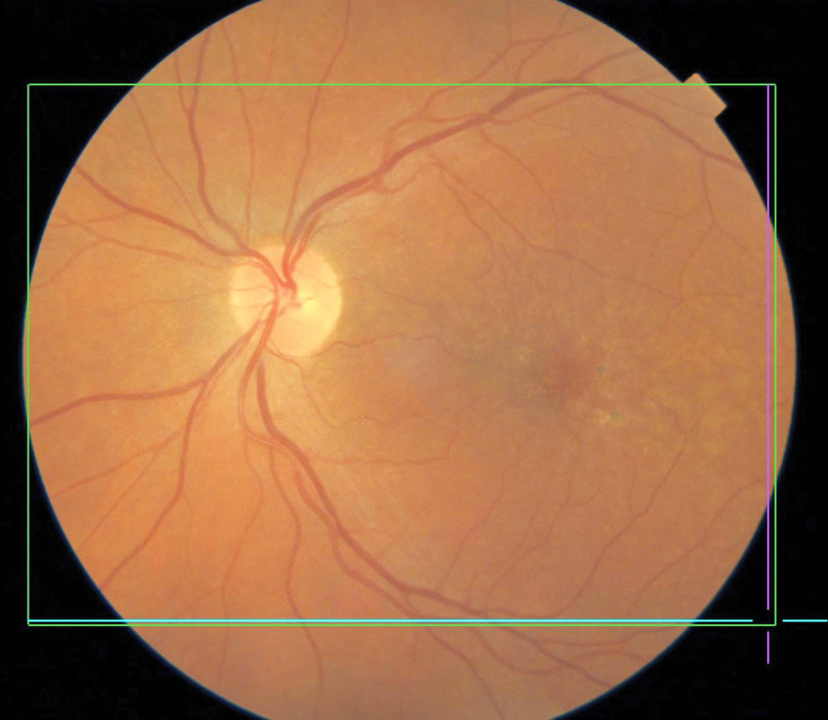 Patients with macular degeneration are at increased risk for dementia and Alzheimer's, study finds. 