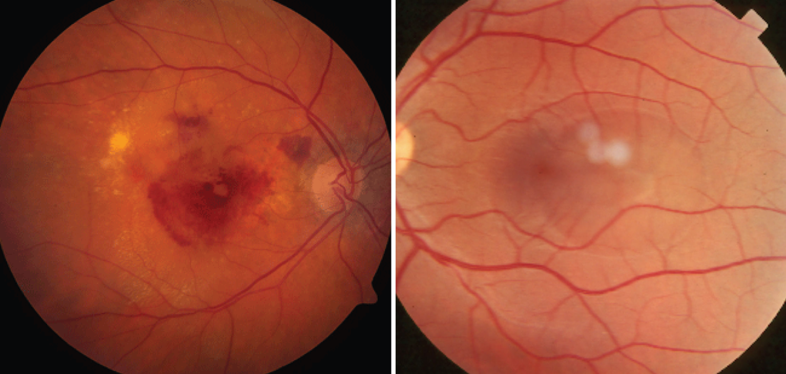 A genome-wide association study found shared loci in age-related macular degeneration (left) and central serous chorioretinopathy (right) that may play a role in both diseases’ development.