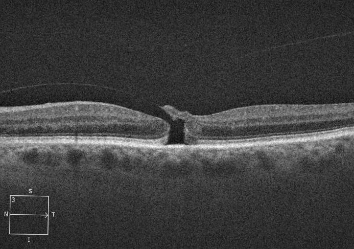 Assessing macular holes using various OCT parameters can help stratify timing of surgery.