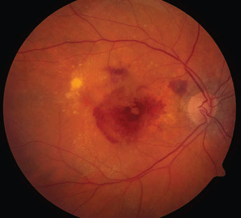 Though it’s rare for patients on anti-VEGF for nAMD or glaucoma to have both diseases, those who do—and those at risk—should be monitored closely.