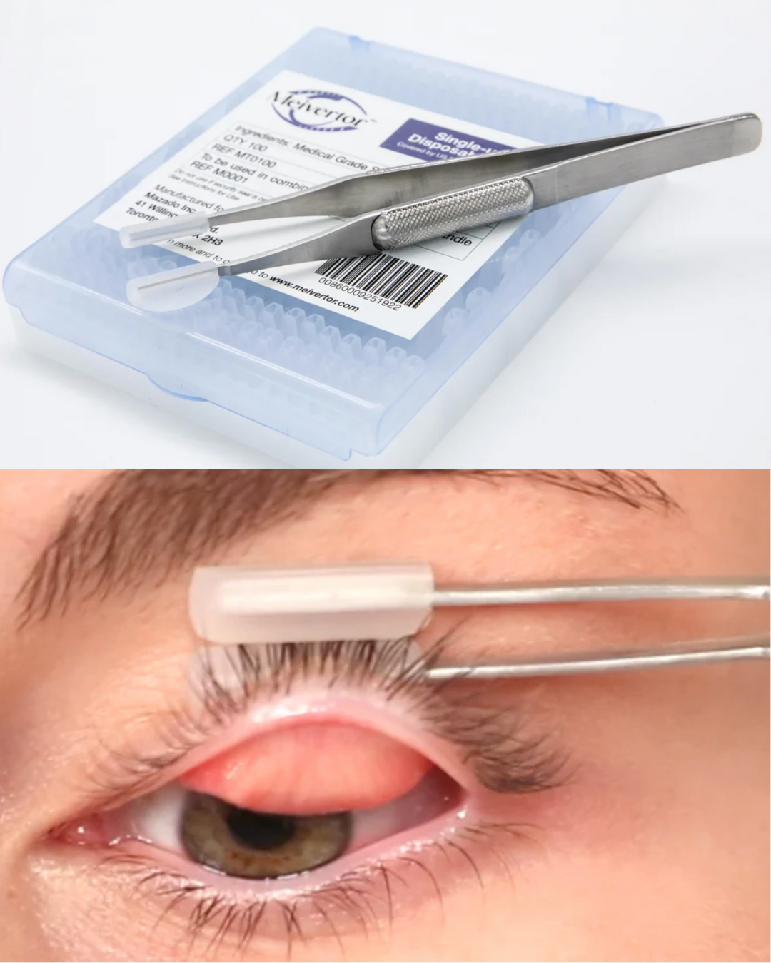 New Meivertor eyelid eversion tool.