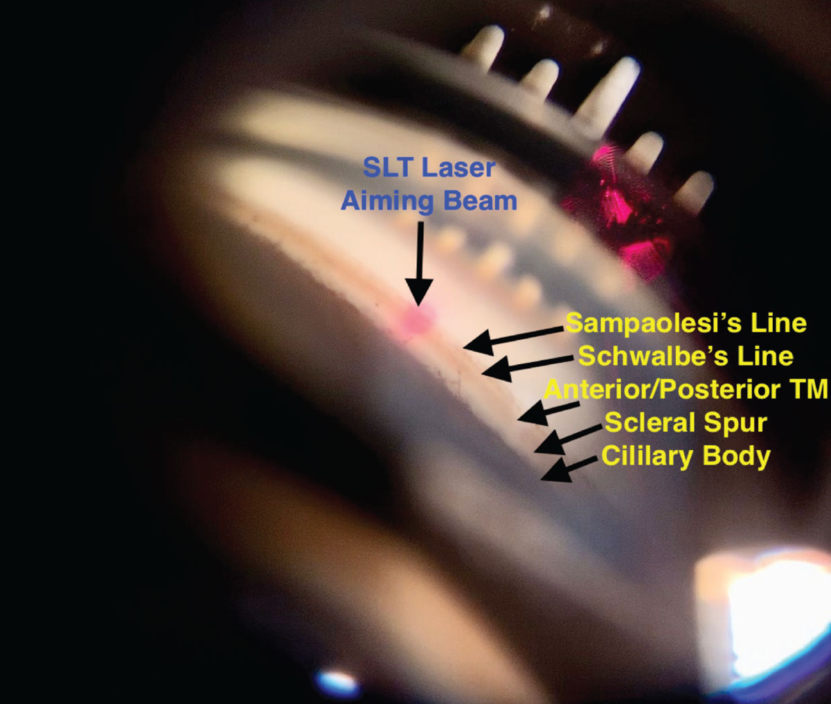 Fig. 4. A view of the angle of an eye through an SLT gonio lens, with the aiming beam focused on the trabecular meshwork.
