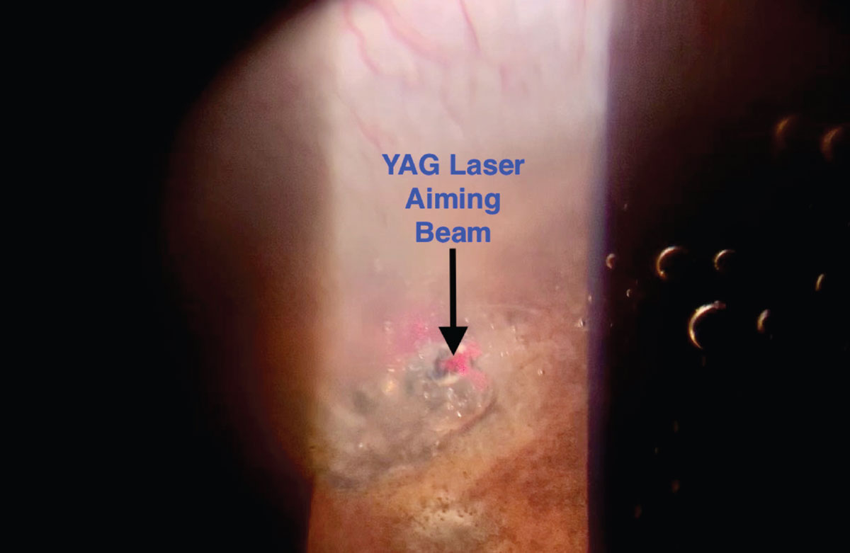 Fig. 7. This is a view of a YAG laser aiming beam focused on an iris crypt with early plume of aqueous into the anterior chamber during LPI. Also note the bubbles and debris beginning to cloud the view.