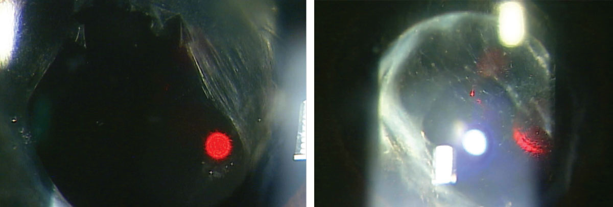 A patient before (left) and after (right) undergoing a YAG posterior capsulotomy.