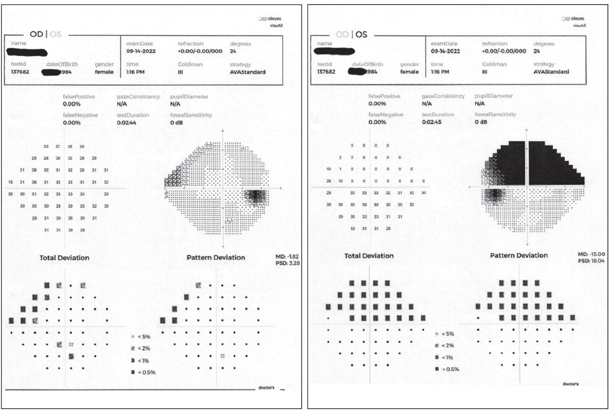 The patient’s right and left visual fields on presentation. Pre-dilation testing showed an early nasal step defect OD and a significant altitudinal defect involving fixation OS.
