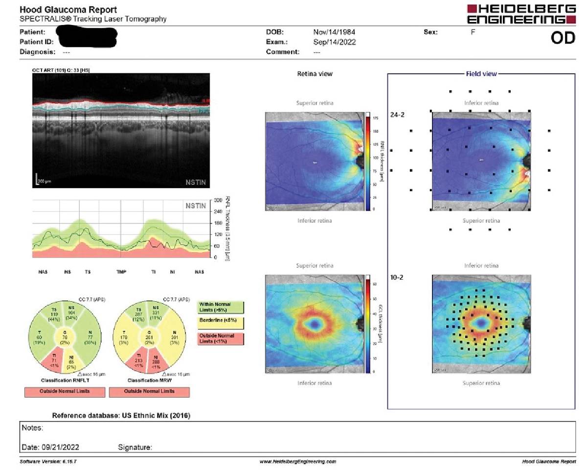On the lower left of the Hood report, note the Garway-Heath sector aberrations in both the RNFL and MRW readings inferotemporally. The RNFL defects are also seen on the NSTIN graph in the middle left of the image. Additionally, there is a wedge defect in the RNFL map in the central column top image under the retina view. Note too the relatively normal ganglion cell map in the lower portion centrally of the image under the retina view.