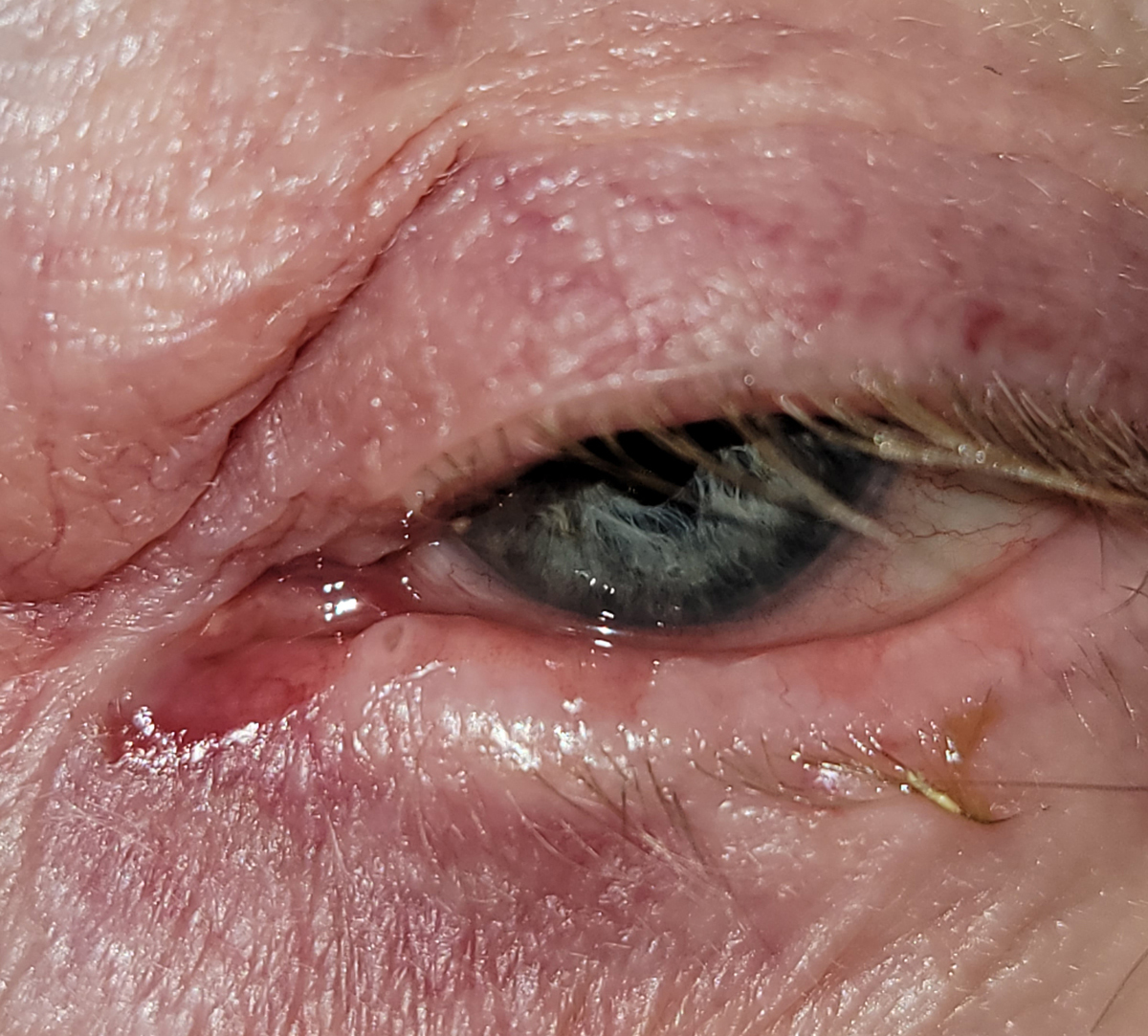 Lacrimal duct obstruction in glaucoma patients may result from chronic exposure to preservatives in topical medications.