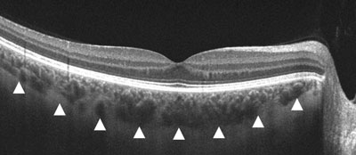 Choroid thickness may eventually serve as a biomarker for myopia progression with more longitudinal evidence to confirm its predictive ability.