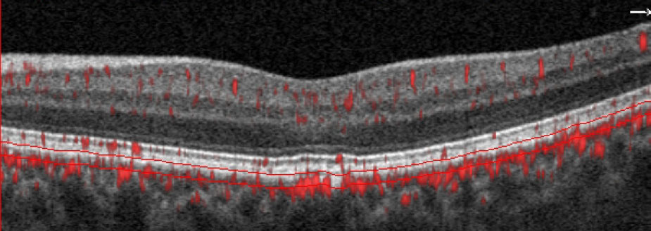 Reduced vessel density of the choriocapillaris was one independent risk factor for visual impairment in a DR nomogram. The others were diabetic macular ischemia grade, disorganization of the retinal inner layers and outer layer disruption.