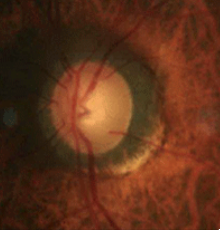 Parapapillary atrophy (seen here in a glaucoma patient), along with optic disc area increase, was more associated with age in the adolescent age group and with SER and AL in the young adult age group.