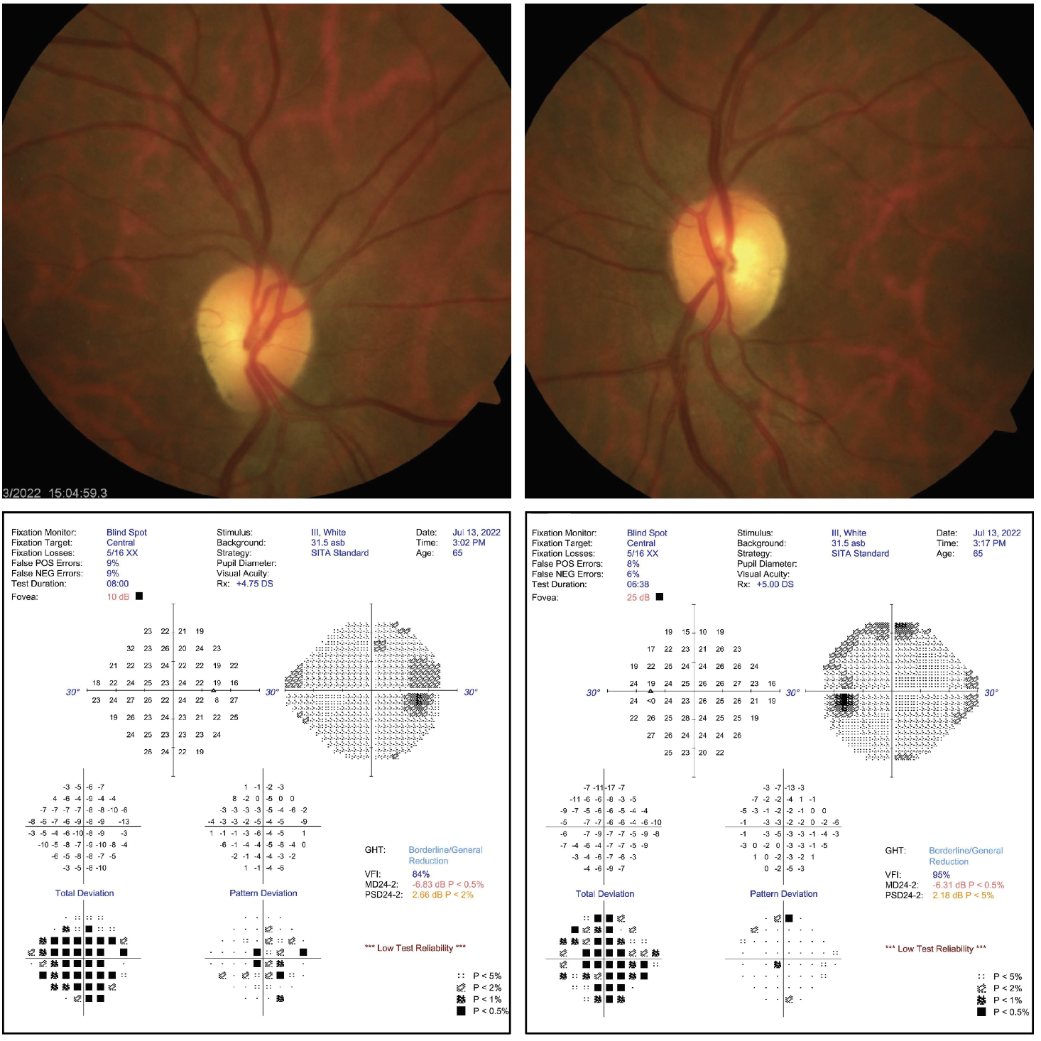 Do you notice any correspondence between the fundus photos and the visual field results? If so, what does it signify?